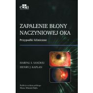 Zapalenie błony naczyniowej oka - 37848a03649ks.jpg